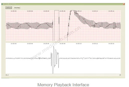 يتضمن تشغيل الذاكرة: ECG، الشبكة، الموجة الصوتية، علامة الوقت المقابلة، زر التشغيل التلقائي، وزر طباعة الصفحة الحالية.
